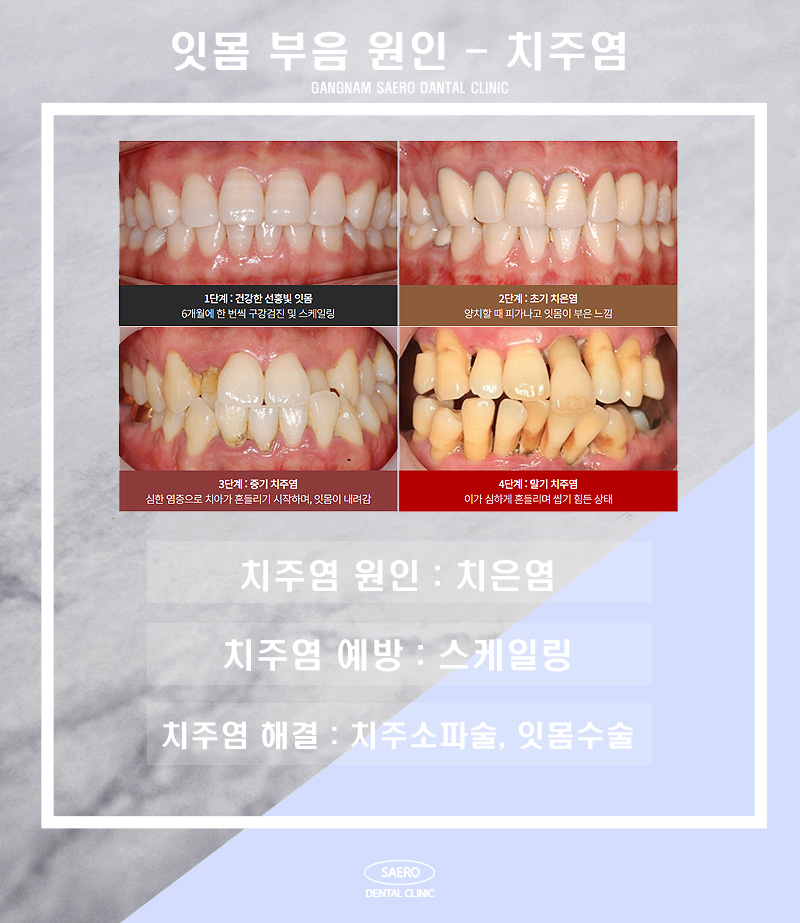 갑자기 잇몸이 부었어요 해결 방법 (잇몸부음원인) 관련 이미지 4