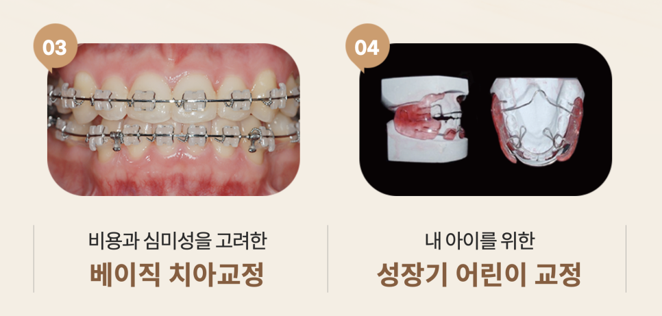 비발치교정치료, 부작용 피하는 방법? 관련 이미지 12