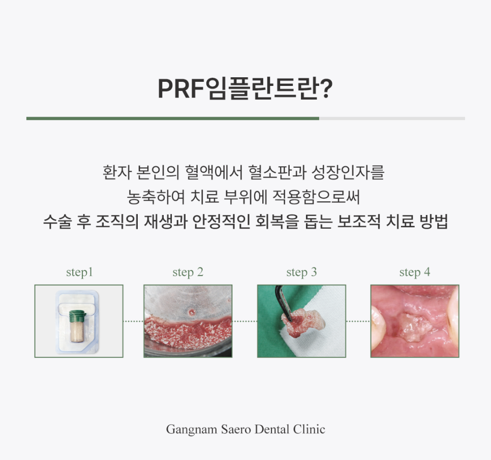65세이상임플란트, 안전한 임플란트 수술 방법 관련 이미지 5