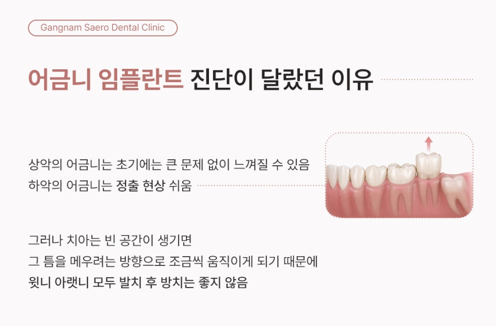어금니 발치 후 임플란트 안 하면 어떻게 될까요? (어금니임플란트) 관련 이미지 4