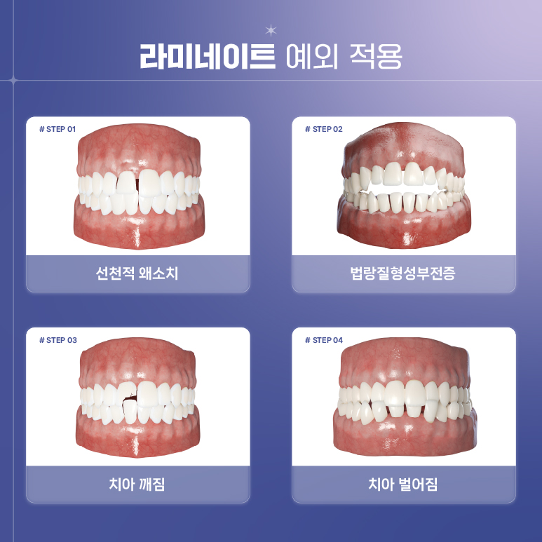 강남역 라미네이트대체 시술 (에어네이트) 관련 이미지 4