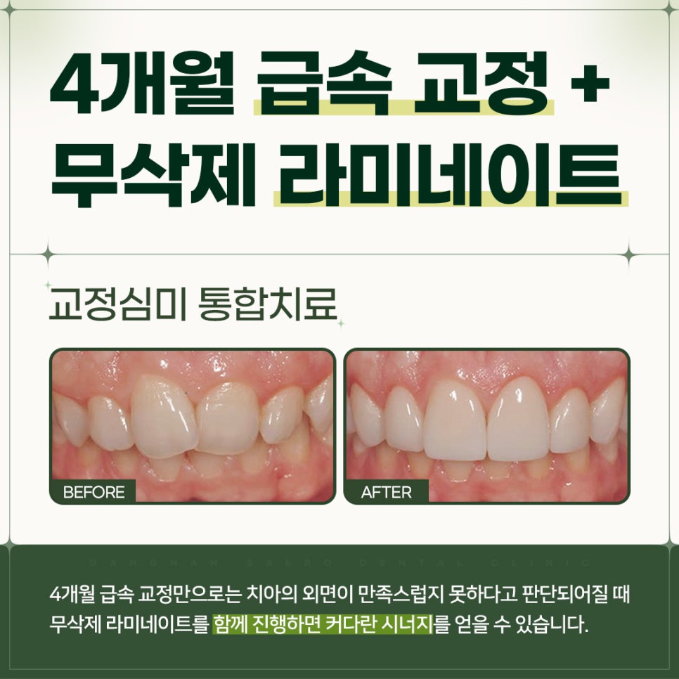 4개월 급속교정 (전체교정은 부담스럽다면 부분교정) [ 강남새로치과 ] 관련 이미지 11