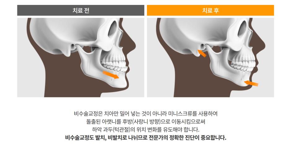 성인 주걱턱 교정 가능합니다! 양악 교정에 대해 알아봅시다! 관련 이미지 3