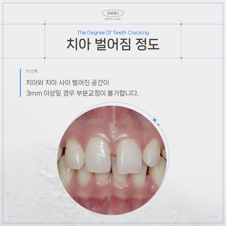 LPA MTA 부분교정 (앞니만 교정하고 싶을 땐 전체교정 대신 부분교정) [ 강남새로치과 ] 관련 이미지 6