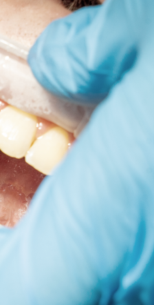 치은염 증상 어떠한 문제들이 있을까요? 관련 이미지 7