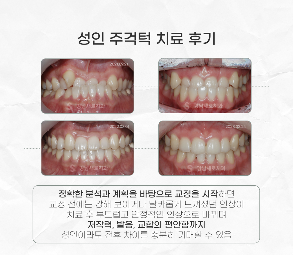 주걱턱 수술 없이 교정하려면 아직 늦지 않은 선택 (성인 비수술주걱턱) 관련 이미지 5