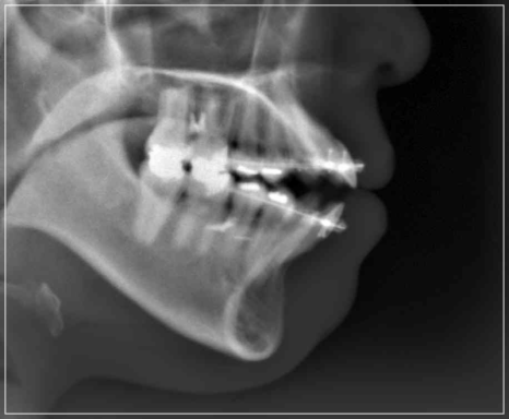 입안다물어짐 비수술로 해결이 가능하다면 관련 이미지 6