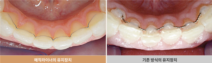 투명교정회사 투명교정종류 투명교정장치 (3) 매직얼라인 관련 이미지 8