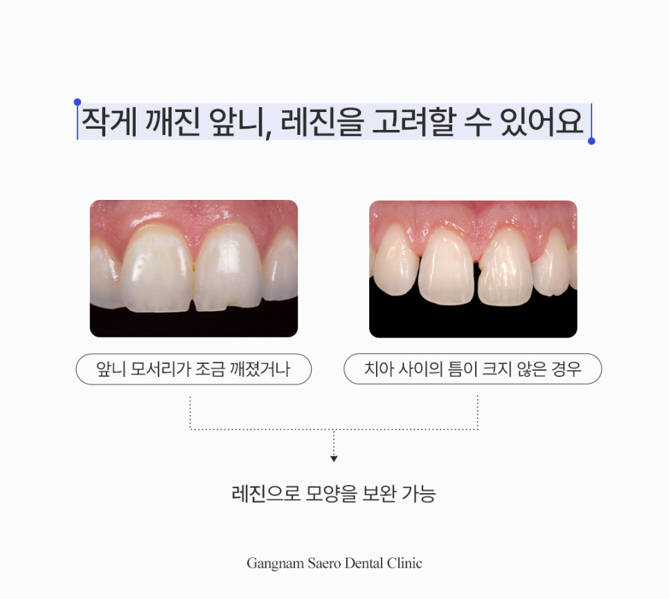 앞니가 깨지거나 벌어졌다면? 레진 치료 안내 관련 이미지 3