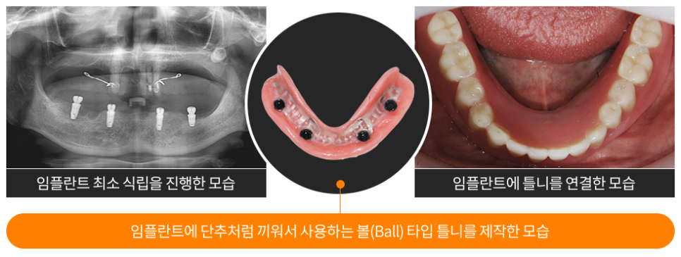 전체임플란트 틀니 중 고민 중이라면 (임플란트틀니) 관련 이미지 5