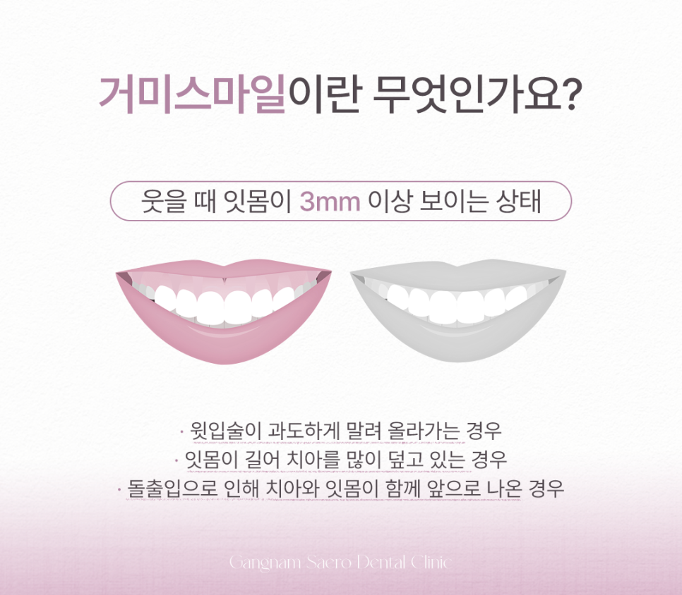 Treatment Methods That Differ Depending on the Cause of Gums Showing When You Smile (Gummy Smile Correction, Gum Contouring) image 2