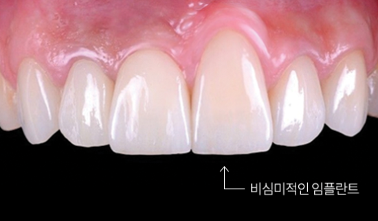 임플란트 부작용 총정리 [ 임플란트 전후 주의사항 ] [ 강남새로치과 ] 관련 이미지 5