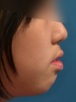 비발치로 뻐드렁니교정을 진행할 수 있다? 관련 이미지 10