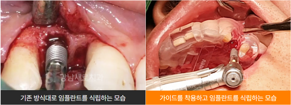 부작용 줄이는 임플란트 [ 네비게이션 임플란트 ] [ 강남새로치과 ] 관련 이미지 7