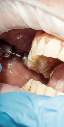 치은염 증상 어떠한 문제들이 있을까요? 관련 이미지 6