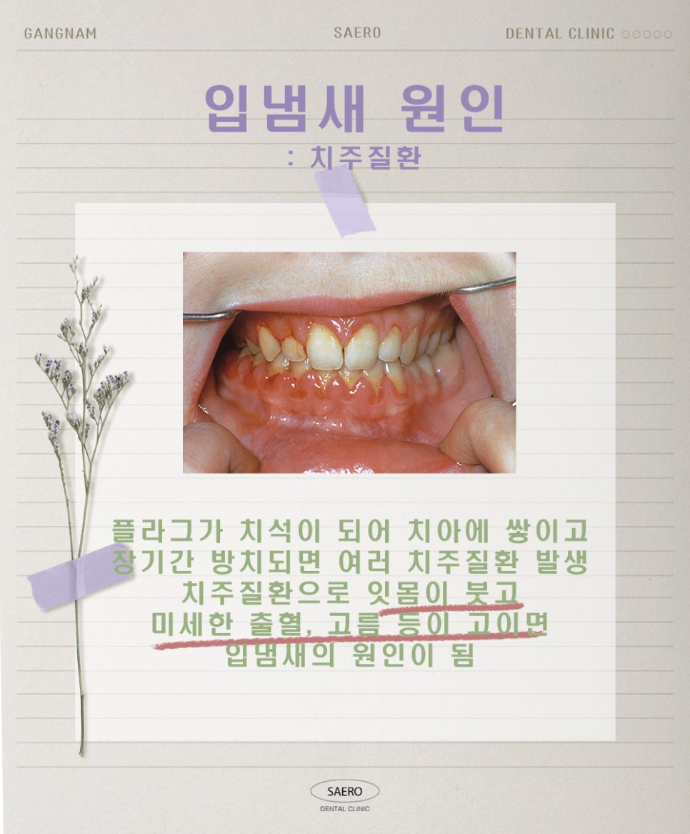 양치질을 해도 입냄새가 난다면 (구취 원인과 해결법) 관련 이미지 6