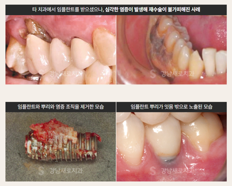 당뇨, 고혈압, 골다공증 환자에게 강남새로치과 의 선택 (PRF임플란트 자가혈임플란트) 관련 이미지 2