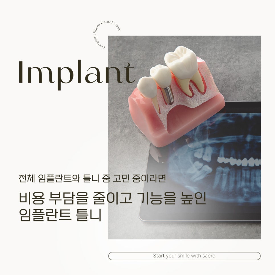 전체임플란트 틀니 중 고민 중이라면 (임플란트틀니) 관련 이미지 1