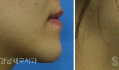 양악전 교정과 양악후 교정, 진행 방법의 차이를 알아보자. 관련 이미지 3