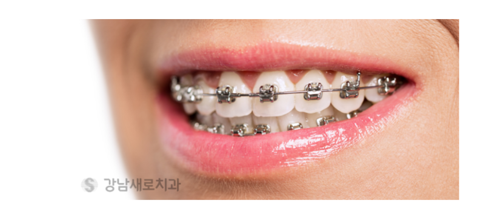 연예인 교정 얼굴 작아지는 법 (교정을 하면 얼굴형이 달라지나요?) [ 강남새로치과 ] 관련 이미지 5