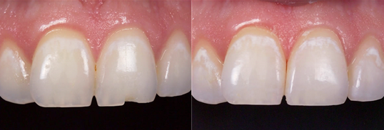 크랙 벌어짐 파절 치아깨짐치료 (레진이란?) 관련 이미지 3