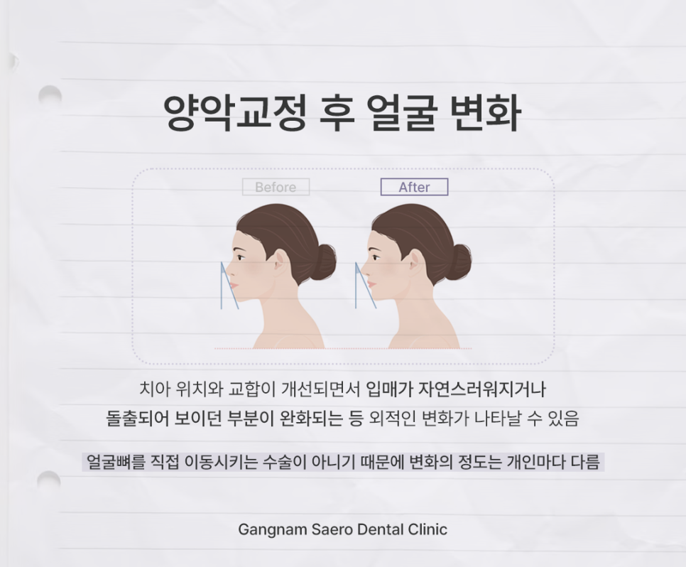 양악교정이란, 수술 없이 얼굴 변화를 만드는 방법 관련 이미지 7