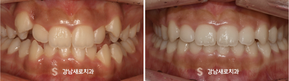 비발치교정치료, 부작용 피하는 방법? 관련 이미지 7