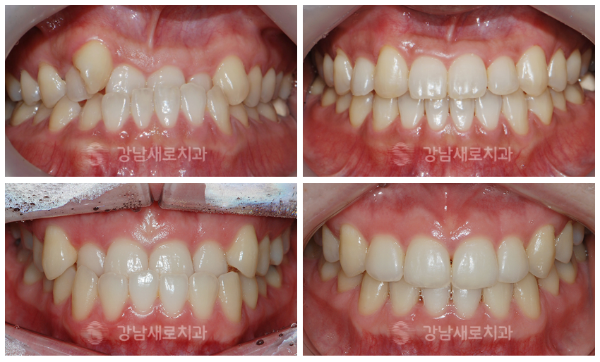 성인주걱턱 지금이라도 수술 없이 가능할까요? (성인주걱턱) 관련 이미지 5