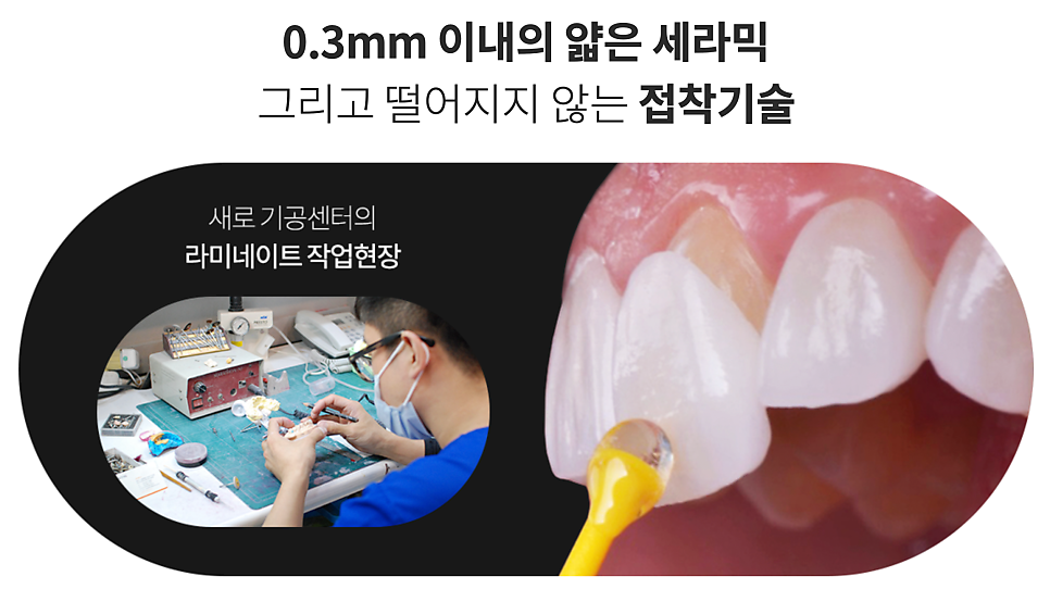 강남역라미네이트, 부작용을 최소화하는 방법? 관련 이미지 7