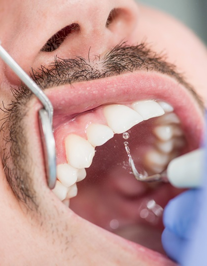 구강질환을 예방하는 치주질환치료 관련 이미지 6