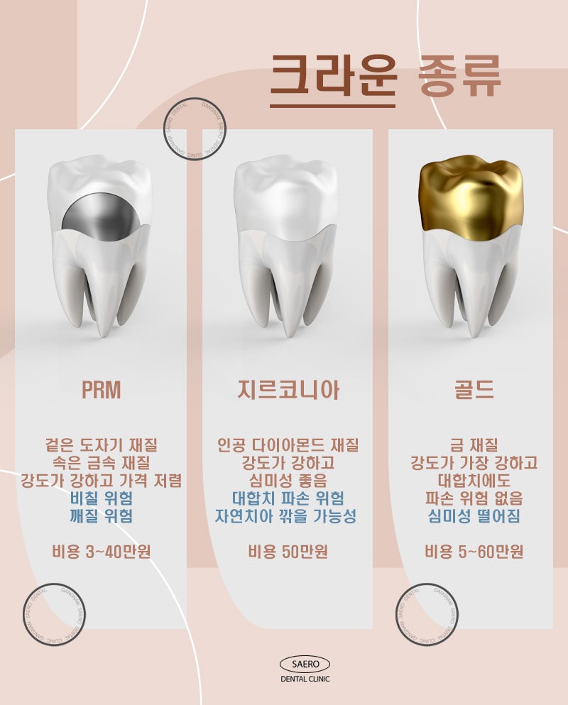 신경치료 이후 충치씌우기 크라운 안내 (크라운 종류와 선택 방법) 관련 이미지 3