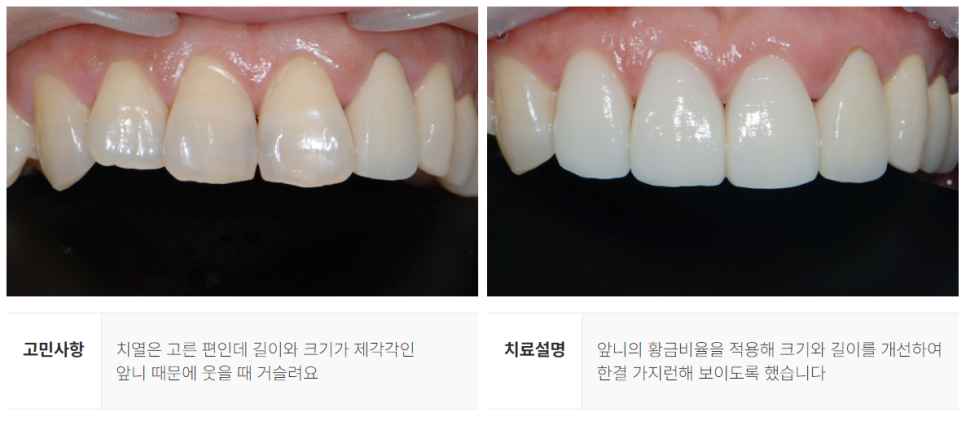 강남역 라미네이트대체 시술 (에어네이트) 관련 이미지 8