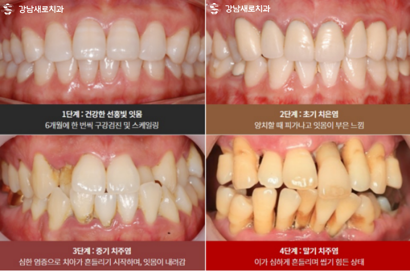 강남역잇몸염증치료, 잇몸피가 나는 원인의 치료방법? 관련 이미지 6