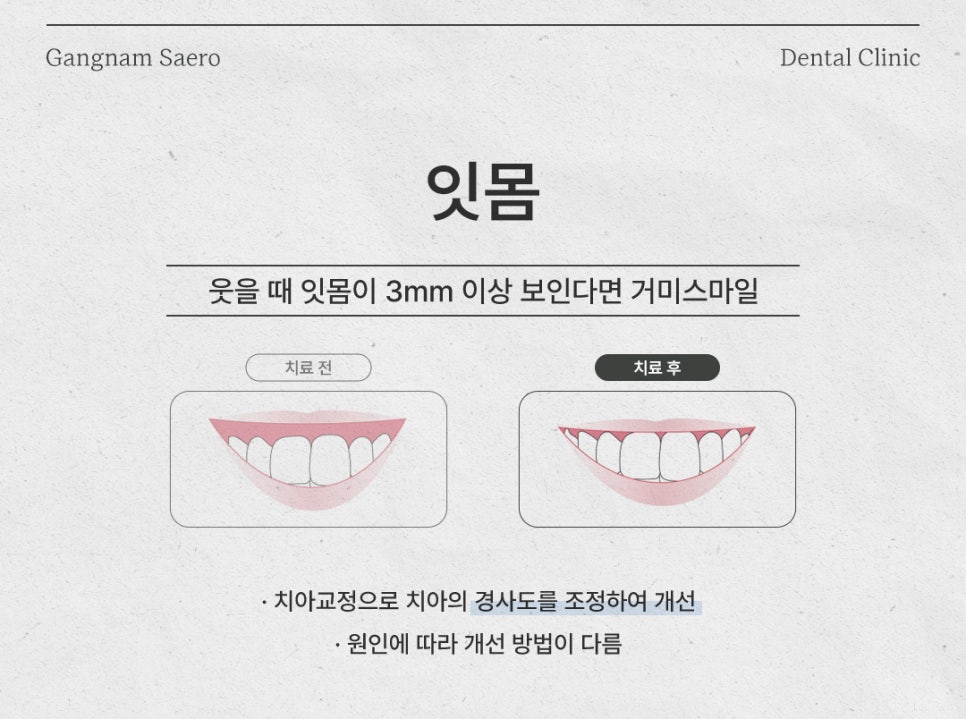 치아교정 으로 해결하는 외모 콤플렉스 (부정교합교정 앞니교정 잇몸교정) 관련 이미지 6