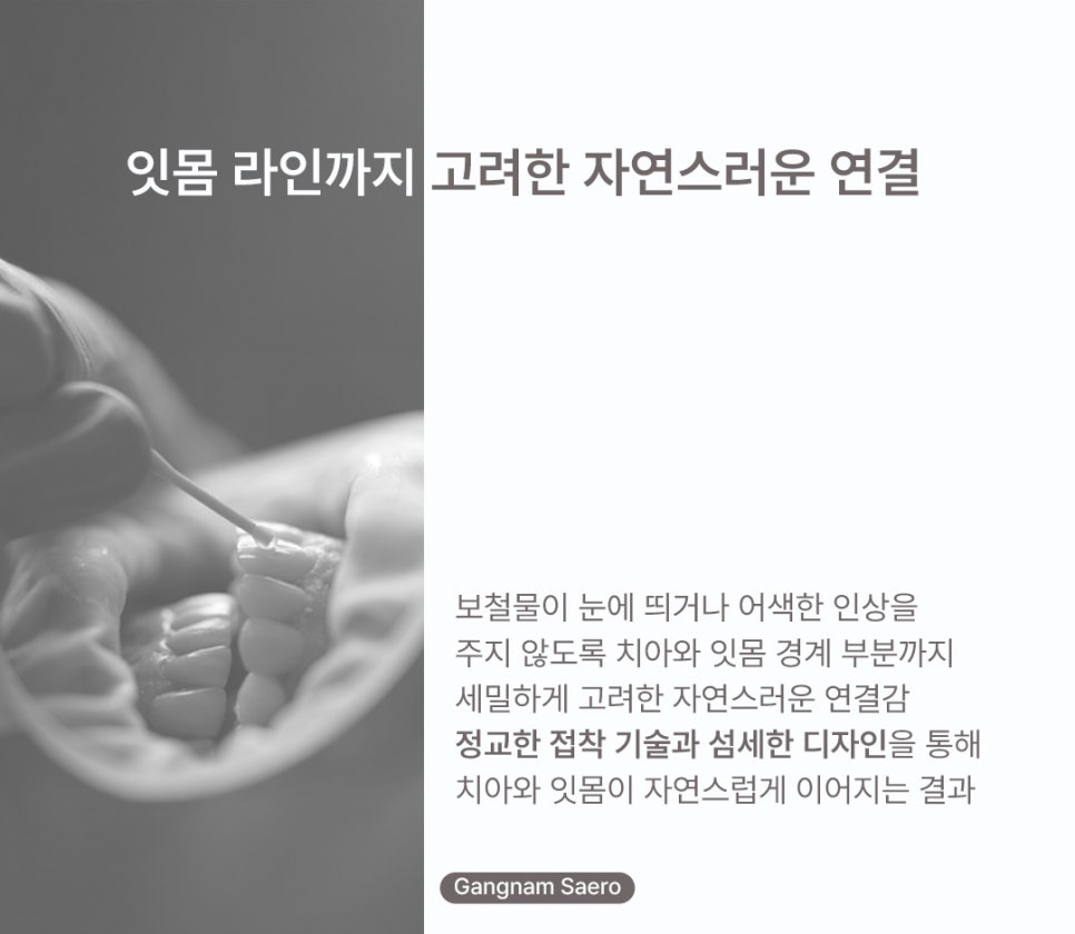 치아 삭제 부담을 줄인 심미 치료 (라미네이트대체 에어네이트) 관련 이미지 6