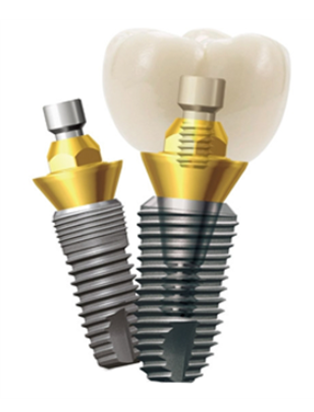 What Is Dentium? (Dentium, an Implant Company) image 3