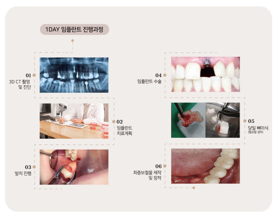 최대 6개월 단축시키는 최단기 임플란트 (당일임플란트) 관련 이미지 5