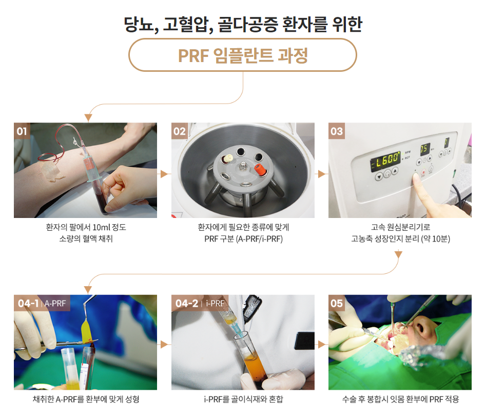 당뇨, 고혈압, 골다공증 대상 임플란트 안내 [ PRF 임플란트 ] [ 강남새로치과 ] 관련 이미지 3