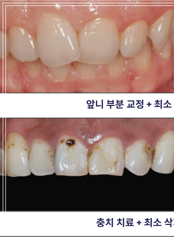 헨리라미네이트, 치아 손상없이 안전하게 진행 관련 이미지 11
