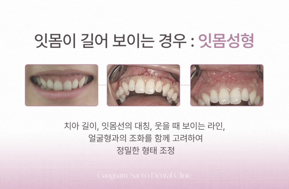 Treatment Methods That Differ Depending on the Cause of Gums Showing When You Smile (Gummy Smile Correction, Gum Contouring) image 3
