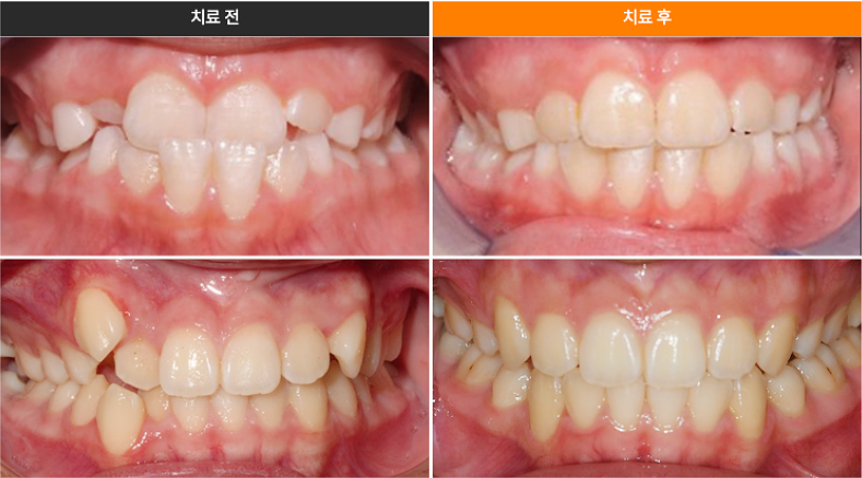 투명치아교정, 발치없이 인비절라인으로 치료 진행 관련 이미지 8
