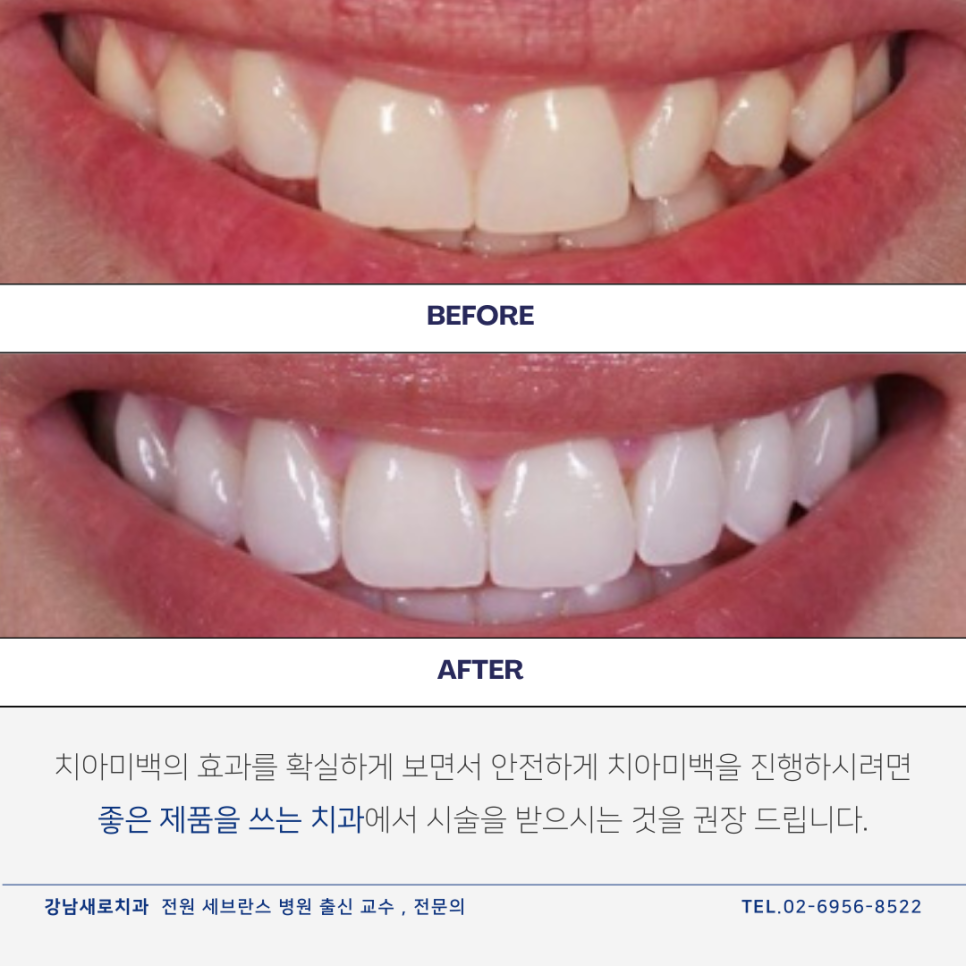 셀프치아미백제, 구매 전 반드시 확인해야 하는 관련 이미지 11