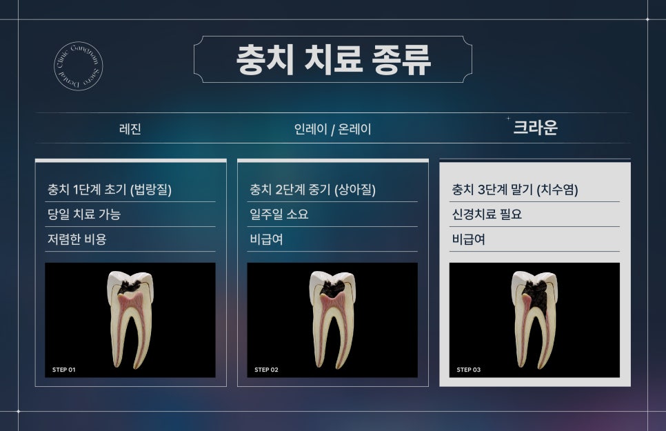 충치치료방법 레진, 인레이/온레이, 크라운 차이 (충치치료비용) 관련 이미지 5