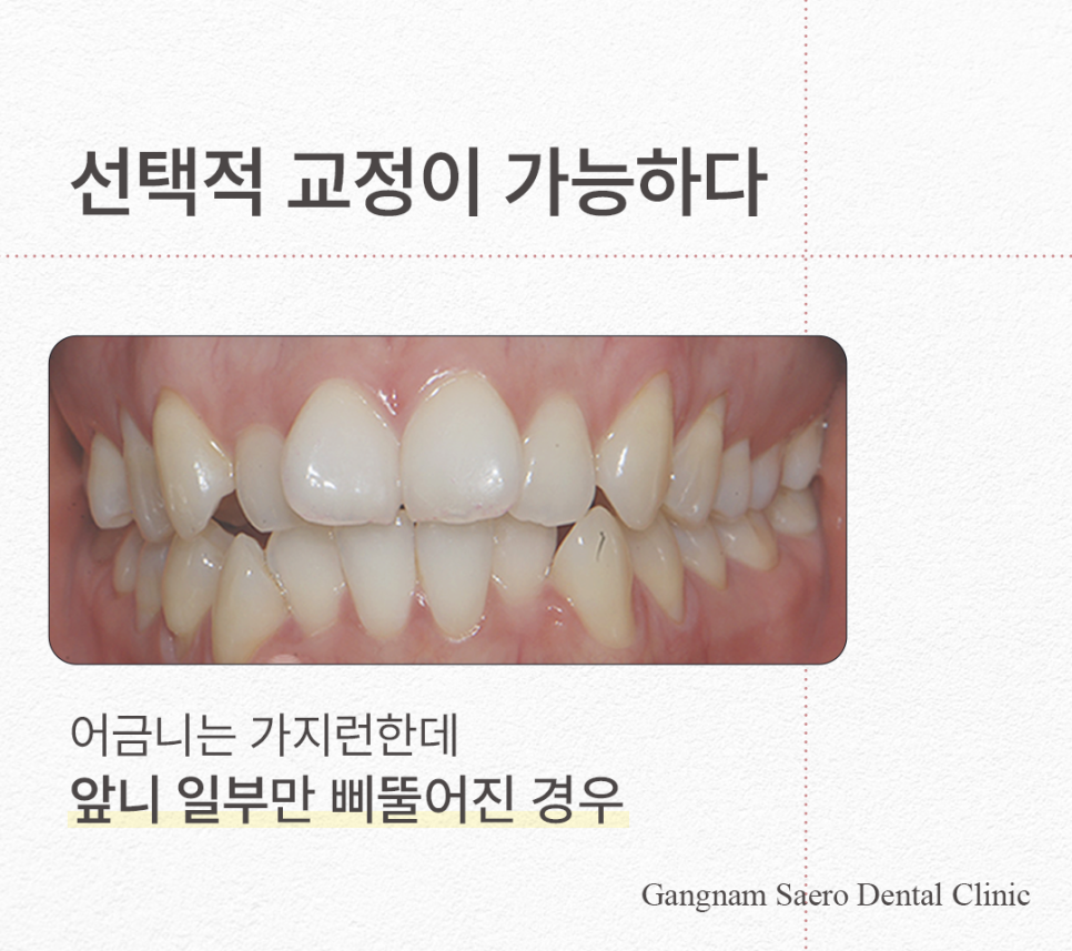 치아 일부만 교정하고 싶다면 비용과 시간을 절약하는 (급속부분교정) 관련 이미지 3