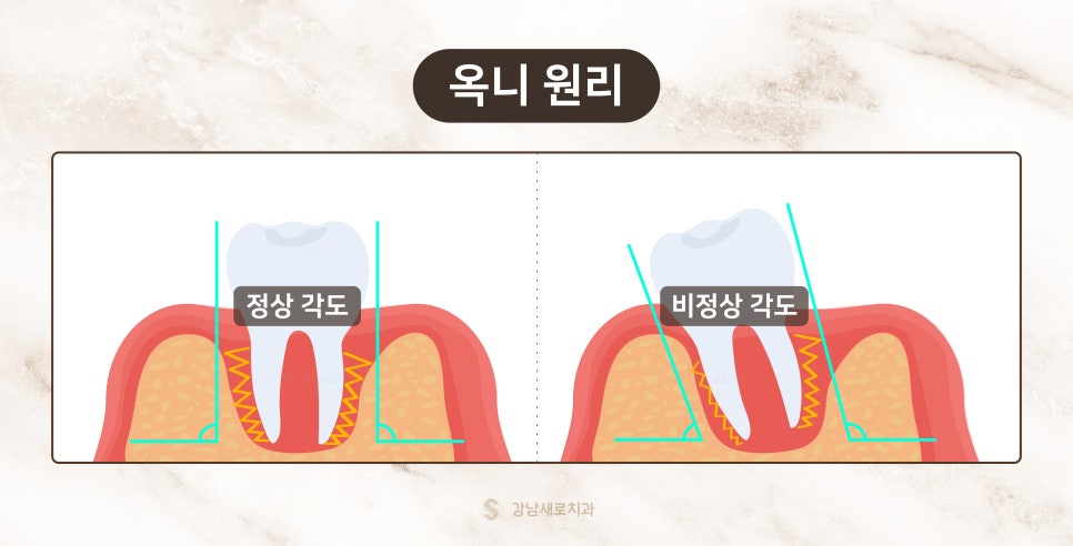 교정 부작용 자세히 알아보기 - 얼굴 변화 원리와 이유 [ 예방 및 대처 방법 ] [ 강남새로치과 ] 관련 이미지 2