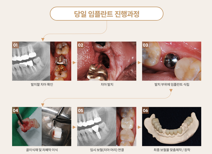 임플란트 추천하는 이유 [ 당일 임플란트 ] [ 강남새로치과 ] 관련 이미지 3