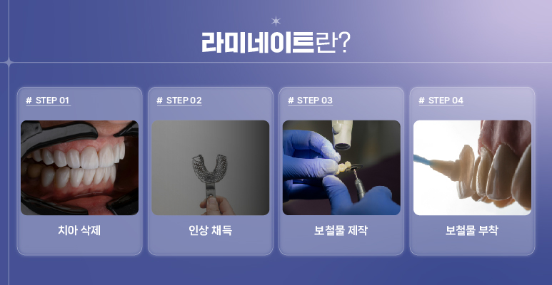 강남역 라미네이트대체 시술 (에어네이트) 관련 이미지 2