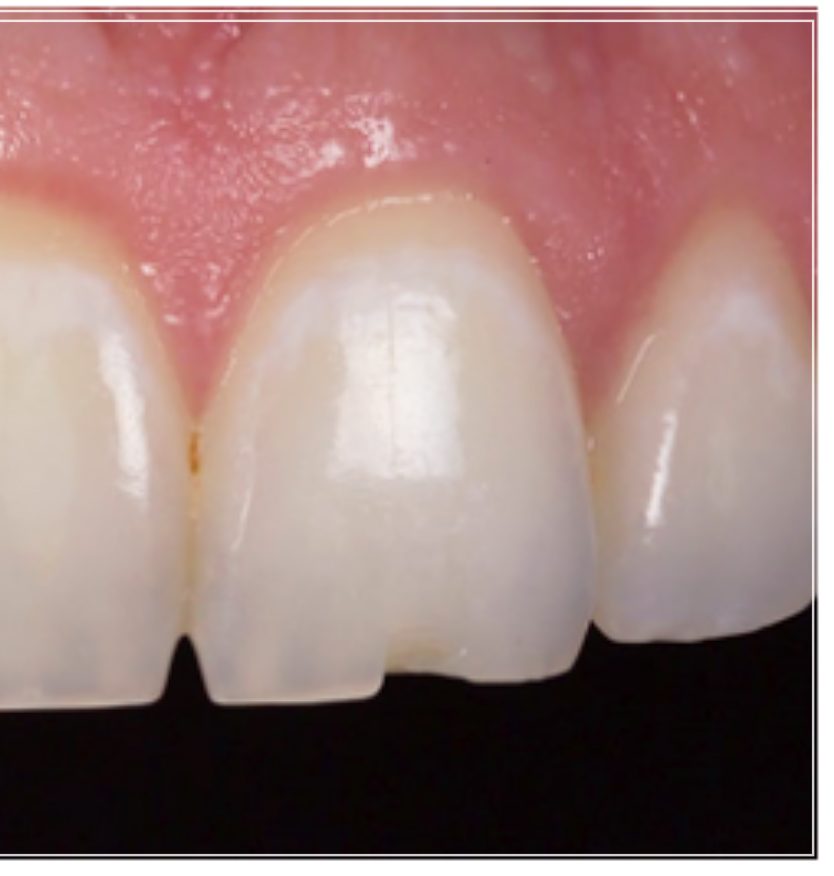 탕후루 치아 손상을 유발? 치료 방법 및 후기 관련 이미지 3