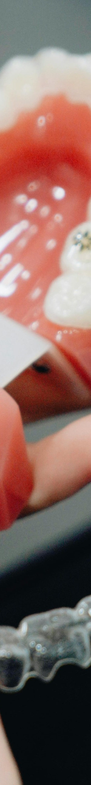 성인치아교정 치료, 부정교합, 구강 건강 개선이 될까요? 고민하고 계시다면 궁금증 타파해드립니다! 관련 이미지 11