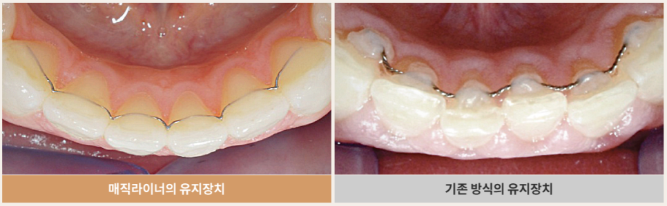 투명교정종류 자세히 알아보기 (3) 매직얼라인 관련 이미지 6
